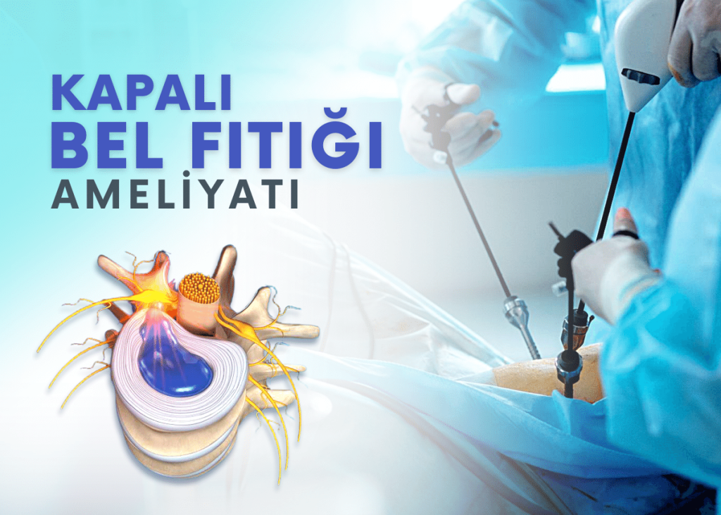 Bel Fıtığı ve Endoskopik Diskektomi: Kapalı Ameliyat Yöntemi